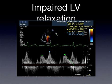 mild lv impairment|is impaired lv relaxation dangerous.